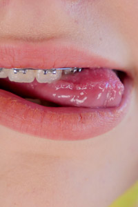 Brace Faced $14.10 Discount